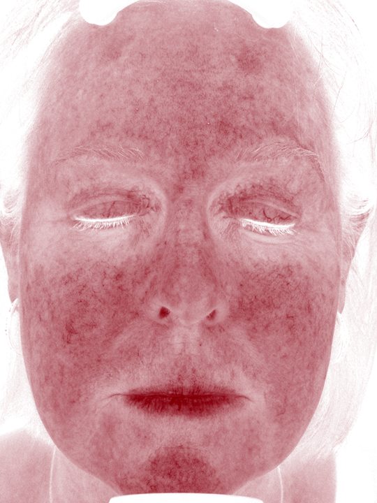 Sherry in the Visia Red Areas view four months later