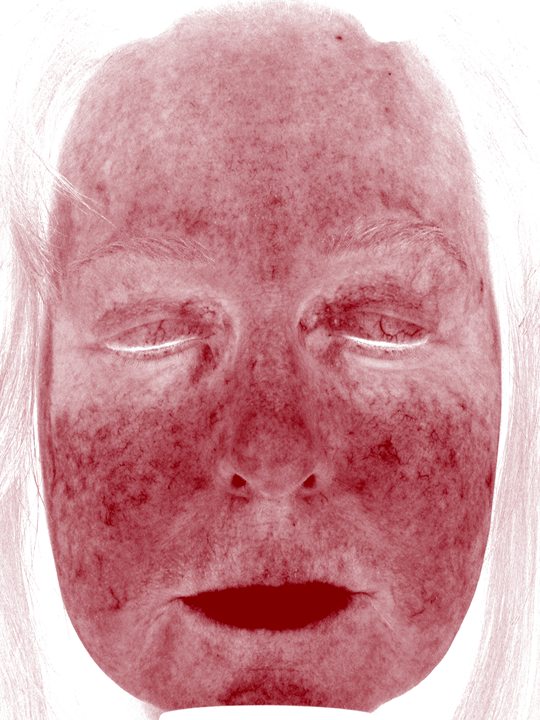 Sherry in the Visia Red Areas view before one Elluminate session