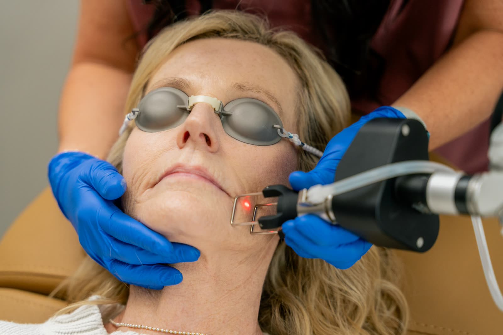 CoolPeel CO2 laser treatment being performed on a guest's jawline