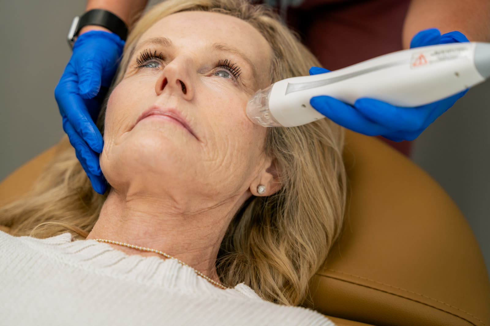 VirtueRF radiofrequency microneedling treatment in progress