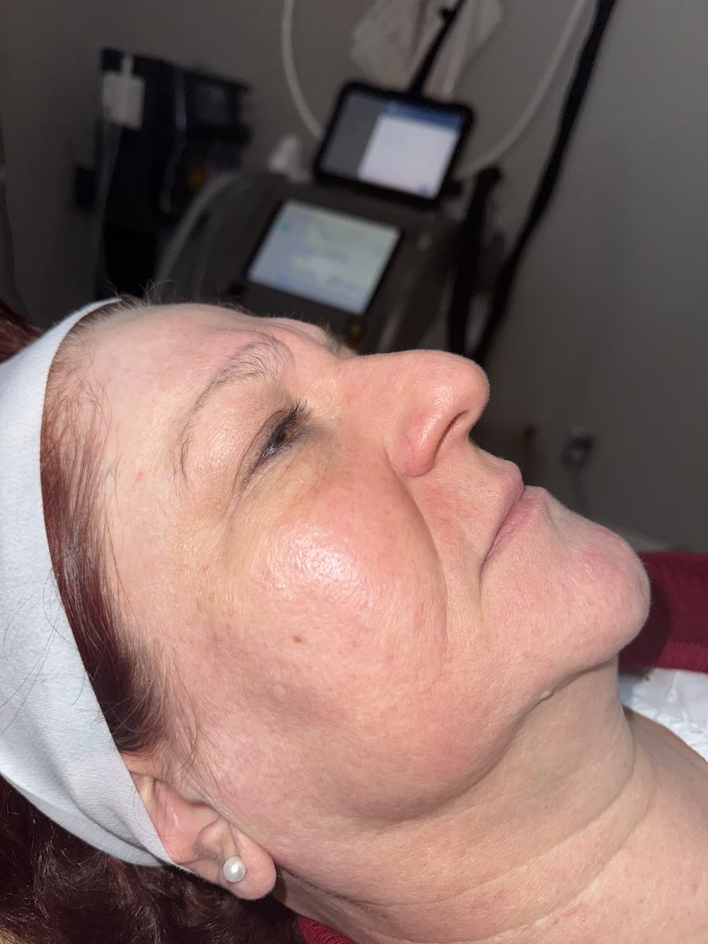 Clearer, brighter skin after the Elluminate laser facial