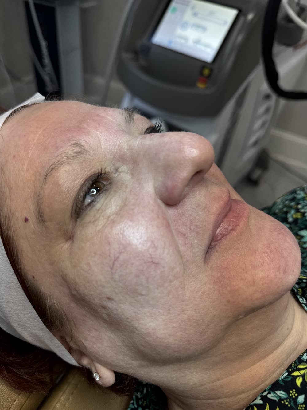Skin before an Elluminate laser facial at Carroll Cosmetic Club