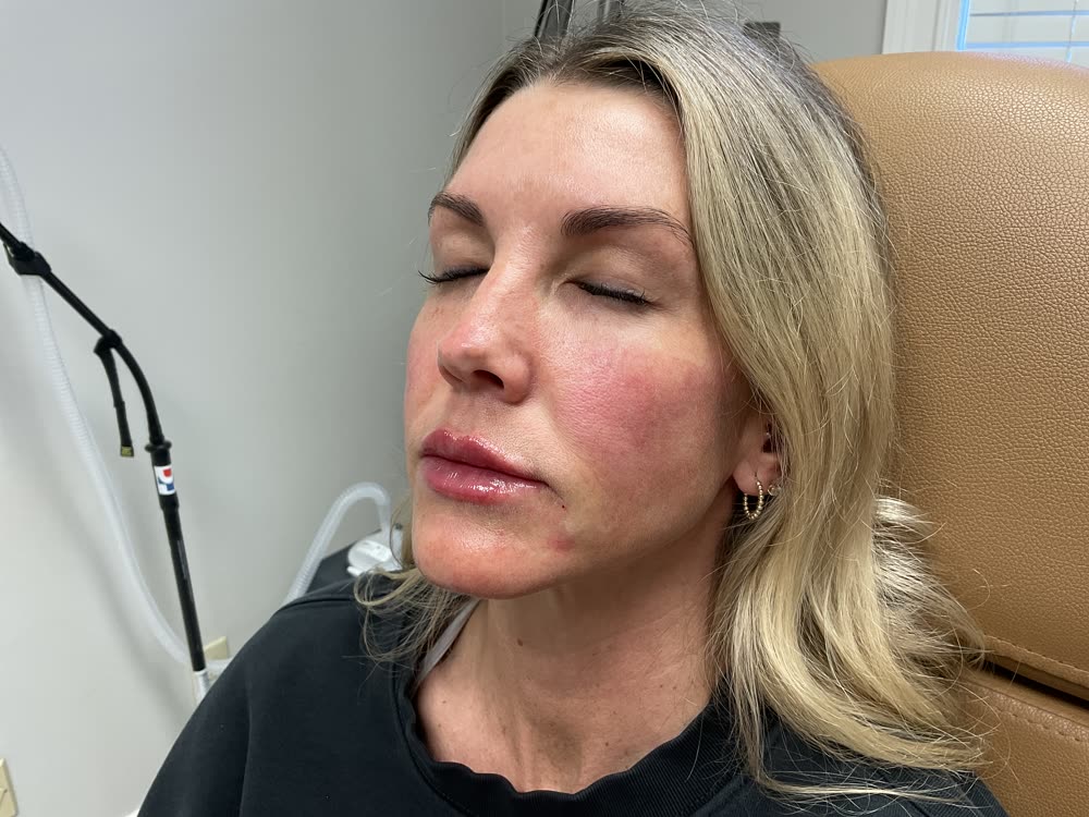 Fuller, defined lips after lip filler