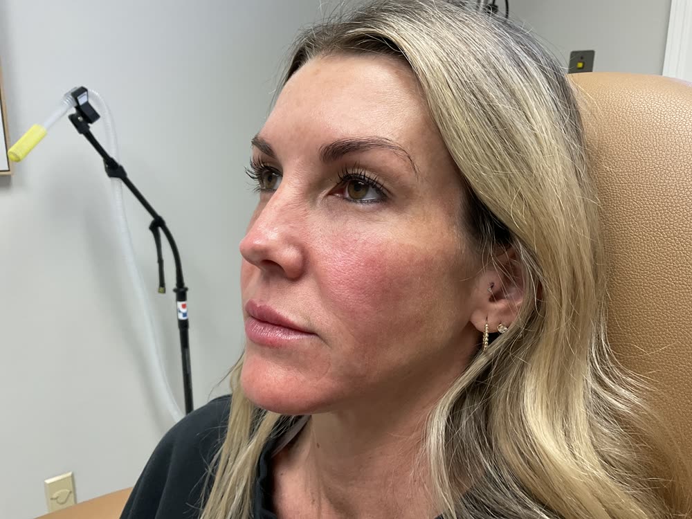 Lips before dermal filler treatment at Carroll Cosmetic Club