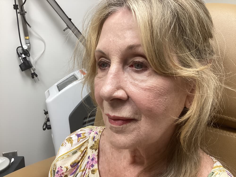 Smoother, refreshed skin after the DEKA laser treatment