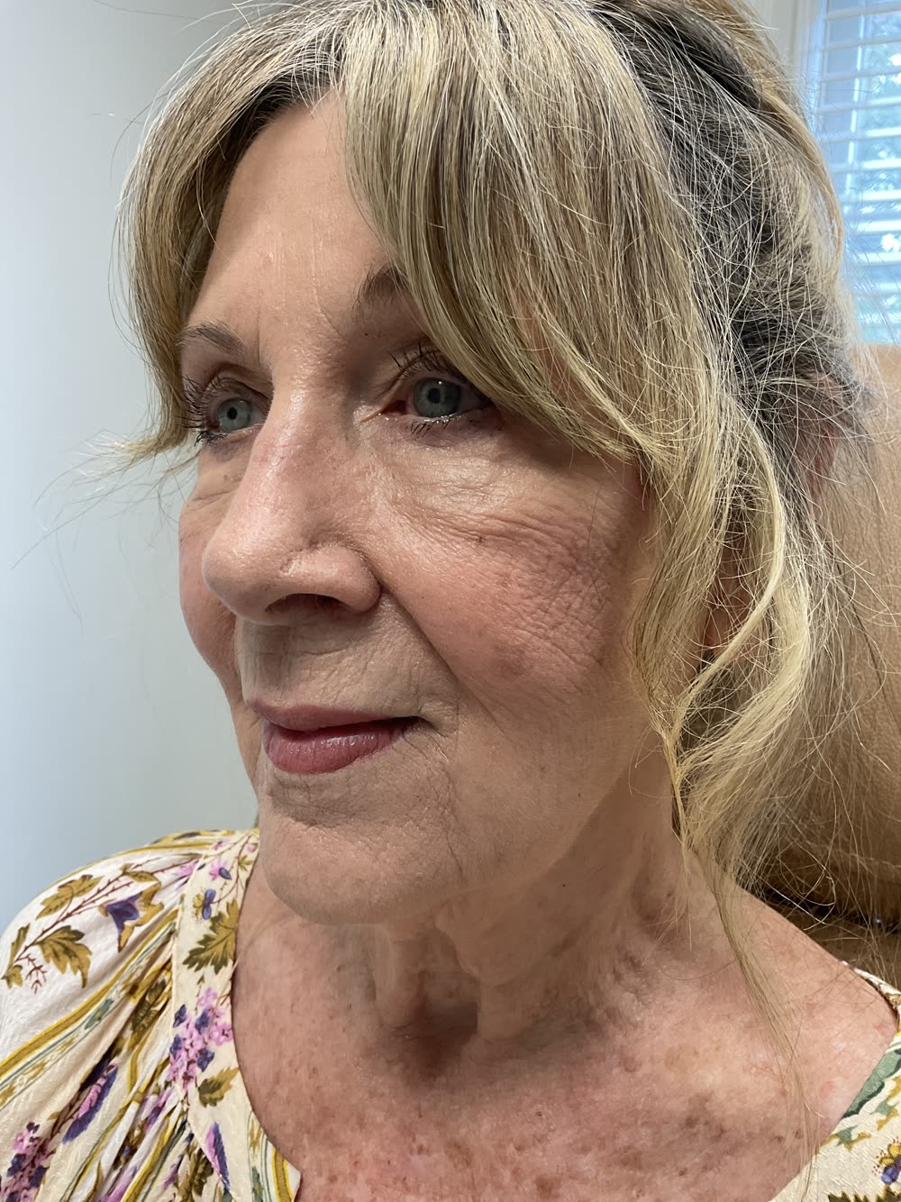 Skin before a DEKA laser treatment at Carroll Cosmetic Club
