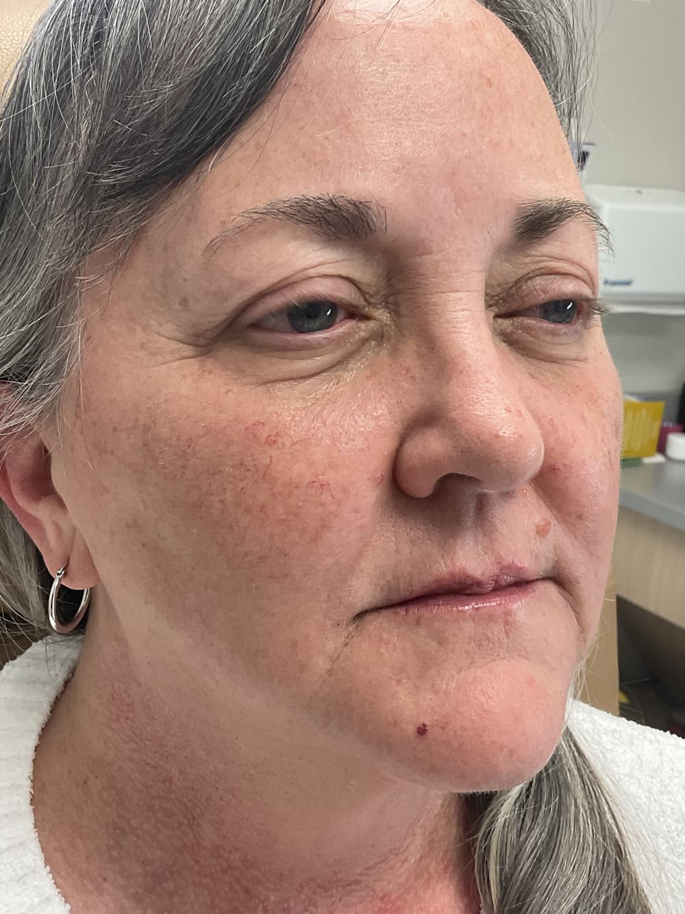 Refreshed lips and softened smile lines after filler