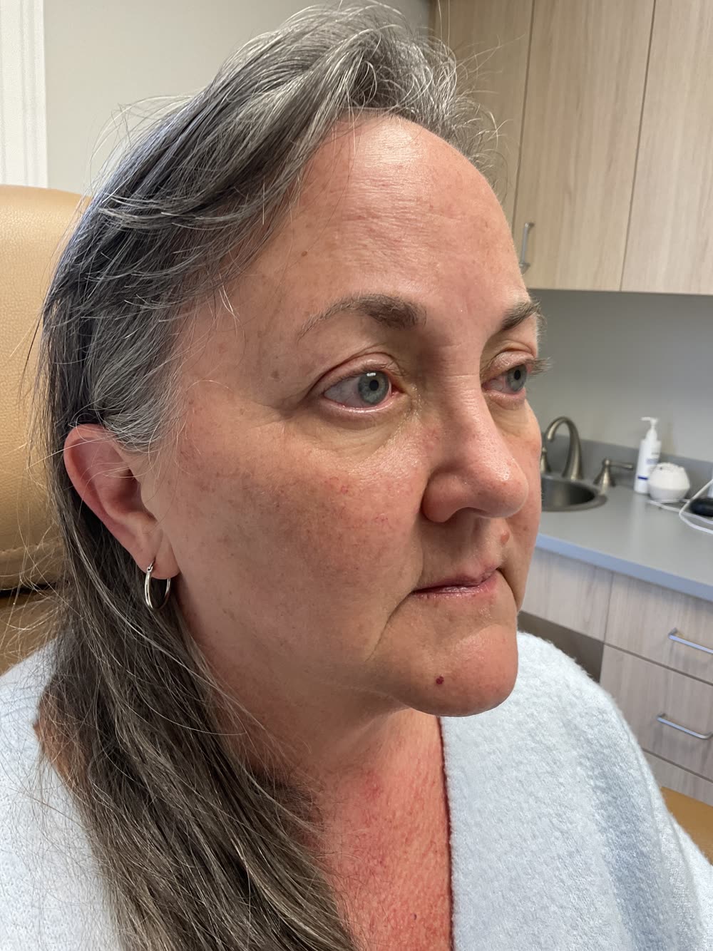 Lips and lower face before filler treatment at Carroll Cosmetic Club